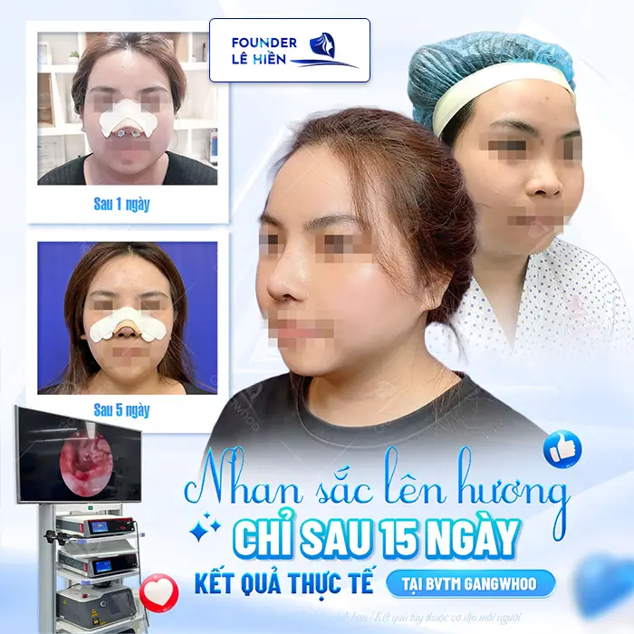 Giải đáp nâng mũi high line được bao lâu?