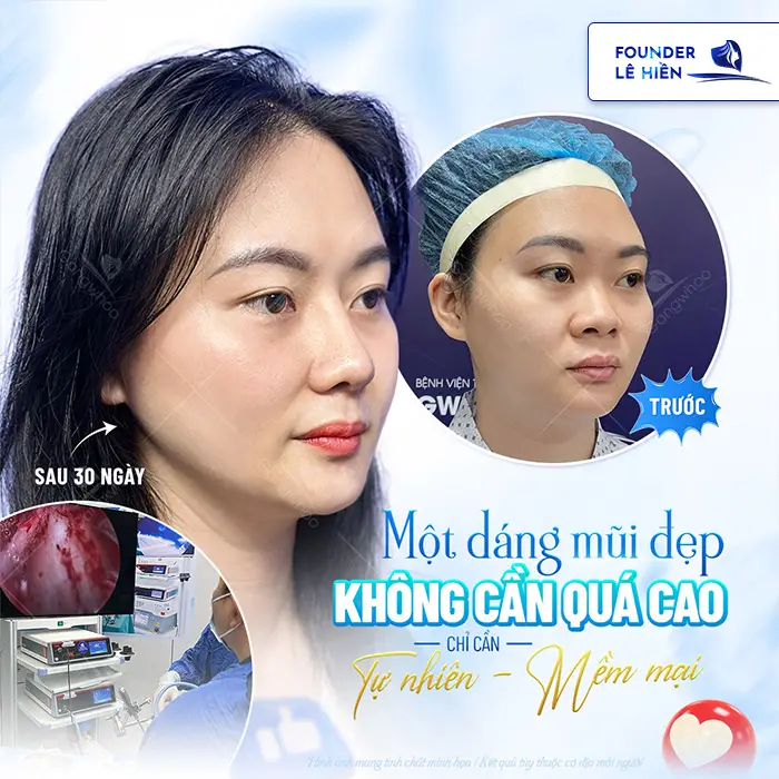 Giải đáp nâng mũi high line được bao lâu?