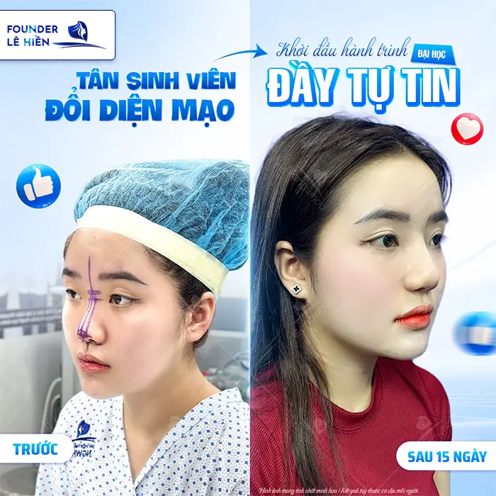 Giải đáp nâng mũi high line được bao lâu?