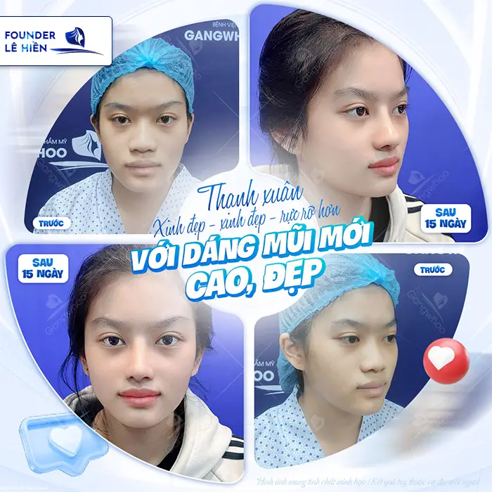 Tìm hiểu nâng mũi high line giá bao nhiêu hiện nay