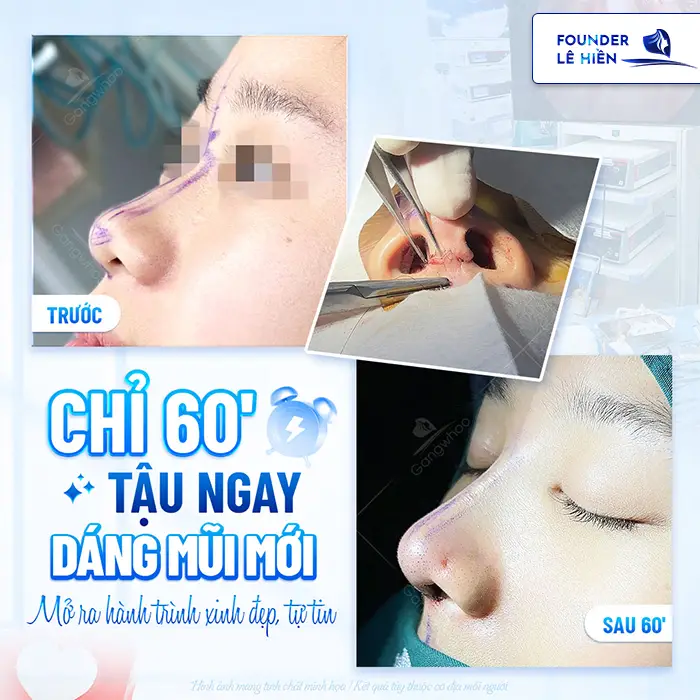 Tìm hiểu nâng mũi high line giá bao nhiêu hiện nay