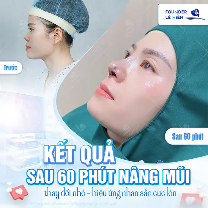 Tìm hiểu nâng mũi high line giá bao nhiêu hiện nay