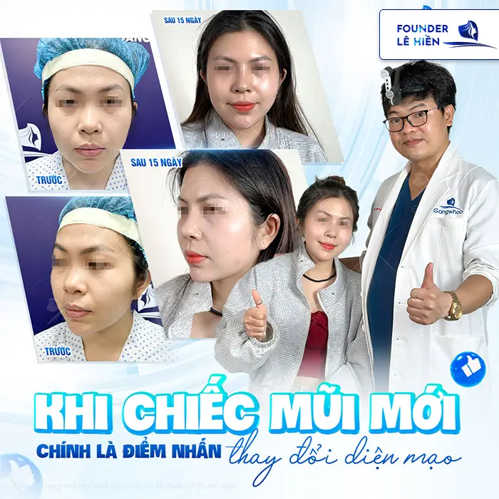 Tìm hiểu nâng mũi high line giá bao nhiêu hiện nay