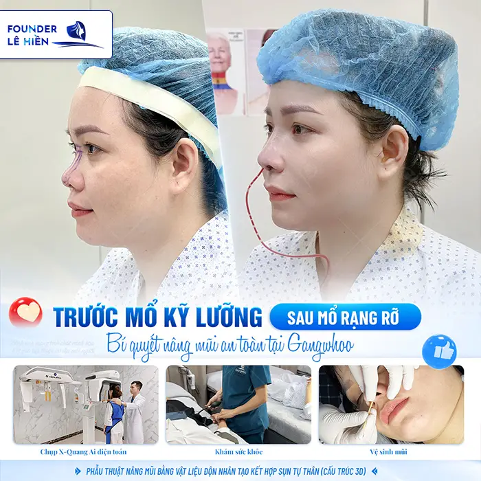 Nâng mũi megaderm là gì? Nâng mũi megaderm có tốt không?