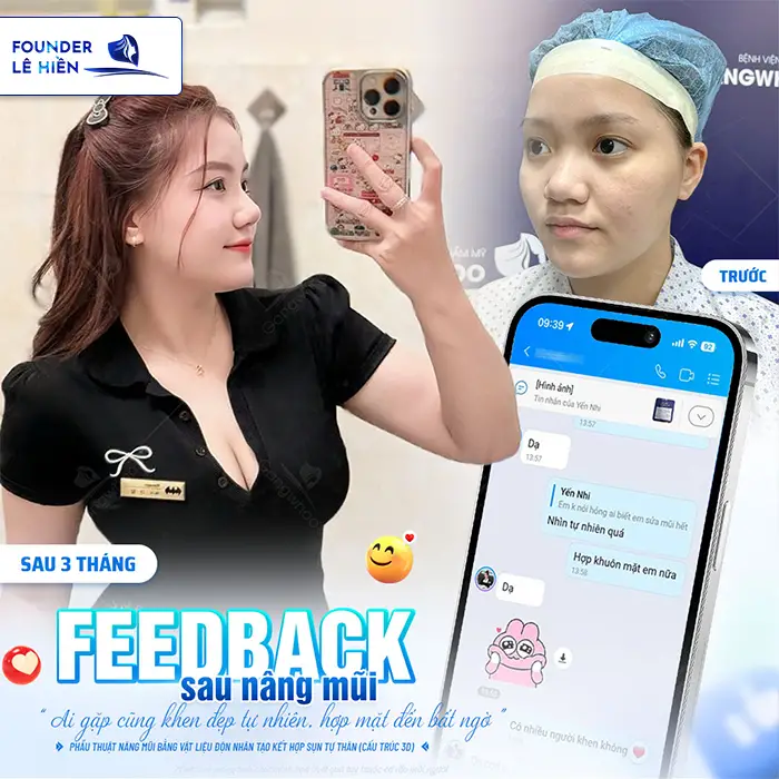 Nâng mũi megaderm là gì? Nâng mũi megaderm có tốt không?