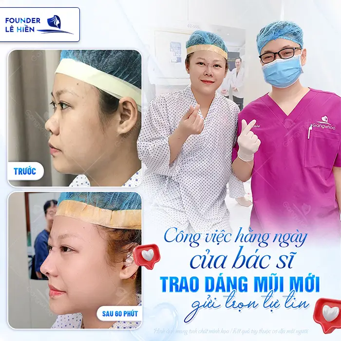 Nâng mũi megaderm là gì? Nâng mũi megaderm có tốt không?