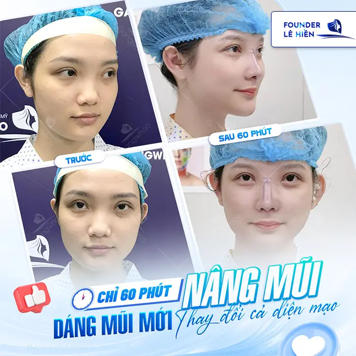 Nâng mũi megaderm là gì? Nâng mũi megaderm có tốt không?