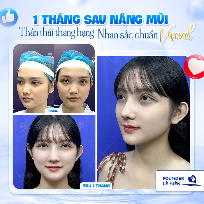 Nâng mũi megaderm là gì? Nâng mũi megaderm có tốt không?