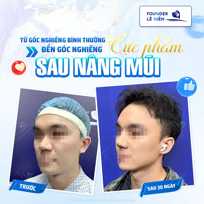 Nâng mũi megaderm là gì? Nâng mũi megaderm có tốt không?