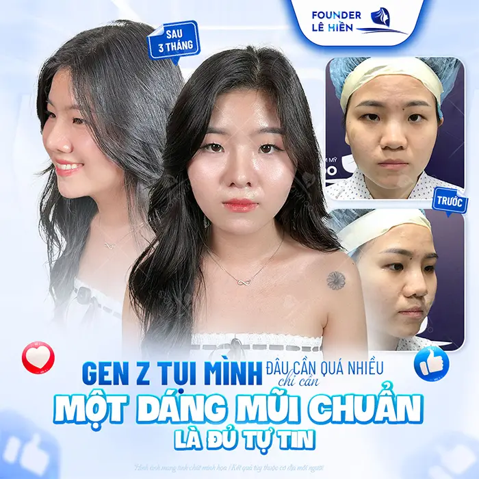 Nâng mũi megaderm được bao lâu? Cách duy trì lâu dài