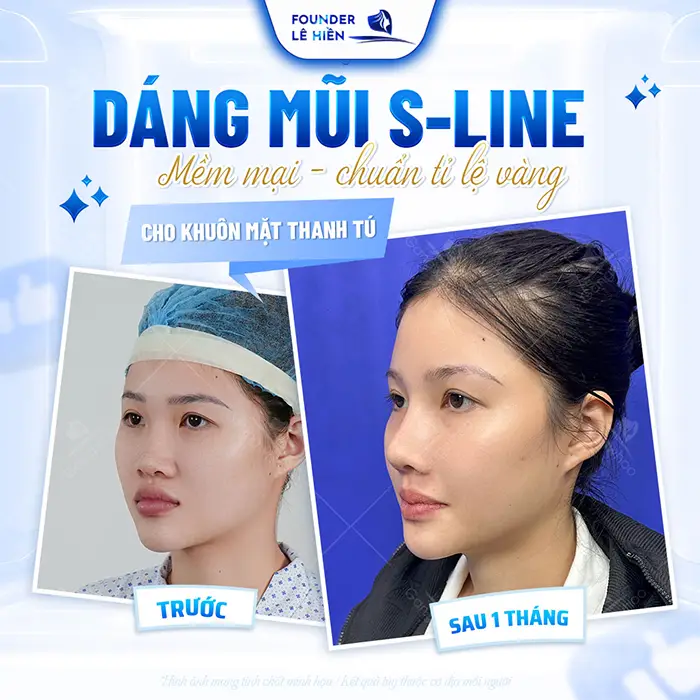 Nâng mũi megaderm được bao lâu? Cách duy trì lâu dài