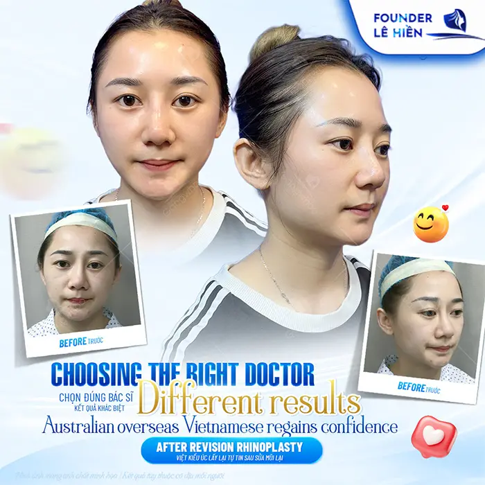 Nâng mũi megaderm được bao lâu? Cách duy trì lâu dài