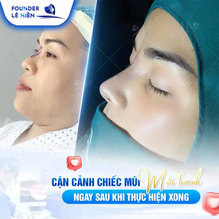 Nâng mũi megaderm được bao lâu? Cách duy trì lâu dài