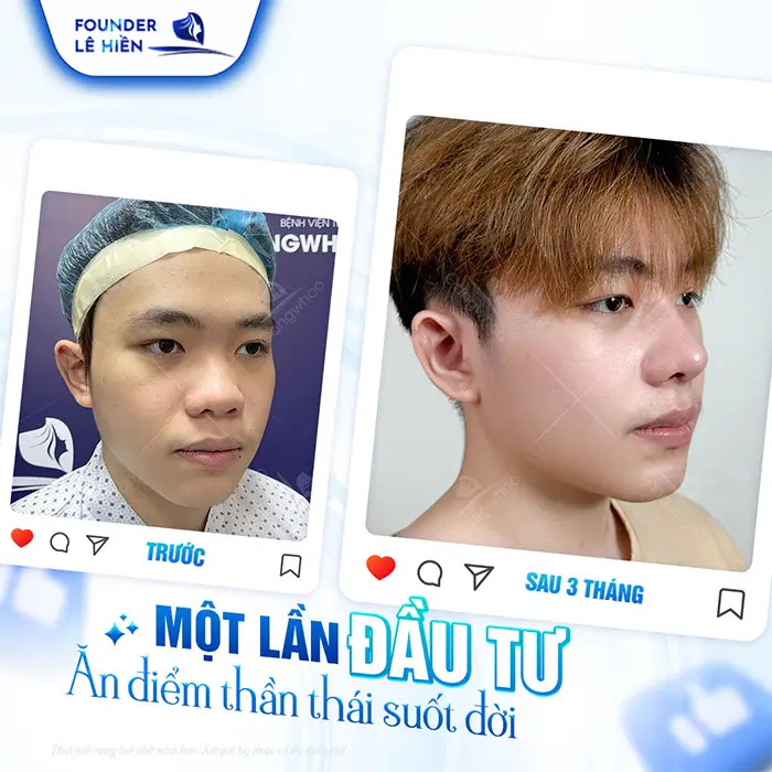 Nâng mũi megaderm được bao lâu? Cách duy trì lâu dài