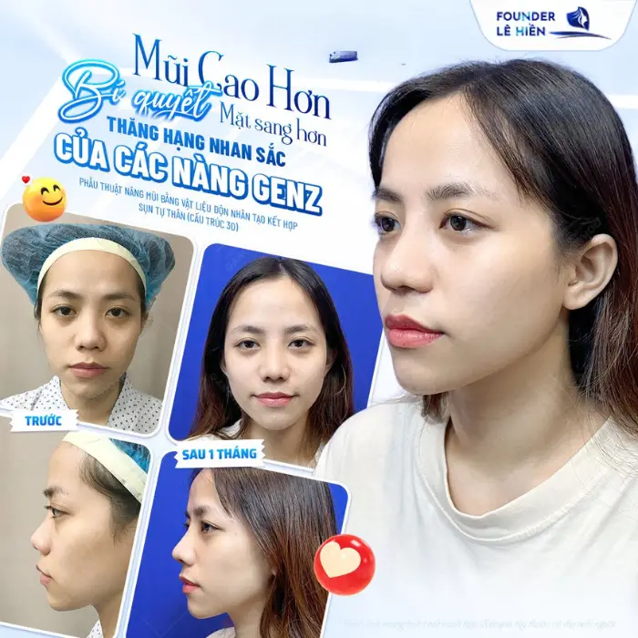 Nâng mũi đẹp từ góc nhìn lâm sàng: Phân tích từng trường hợp và phương pháp tối ưu