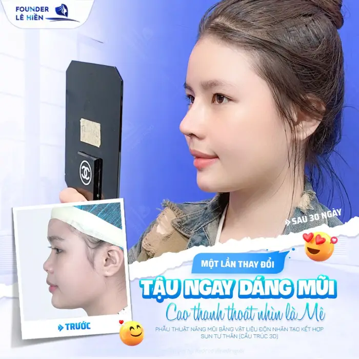 Nâng mũi đẹp từ góc nhìn lâm sàng: Phân tích từng trường hợp và phương pháp tối ưu