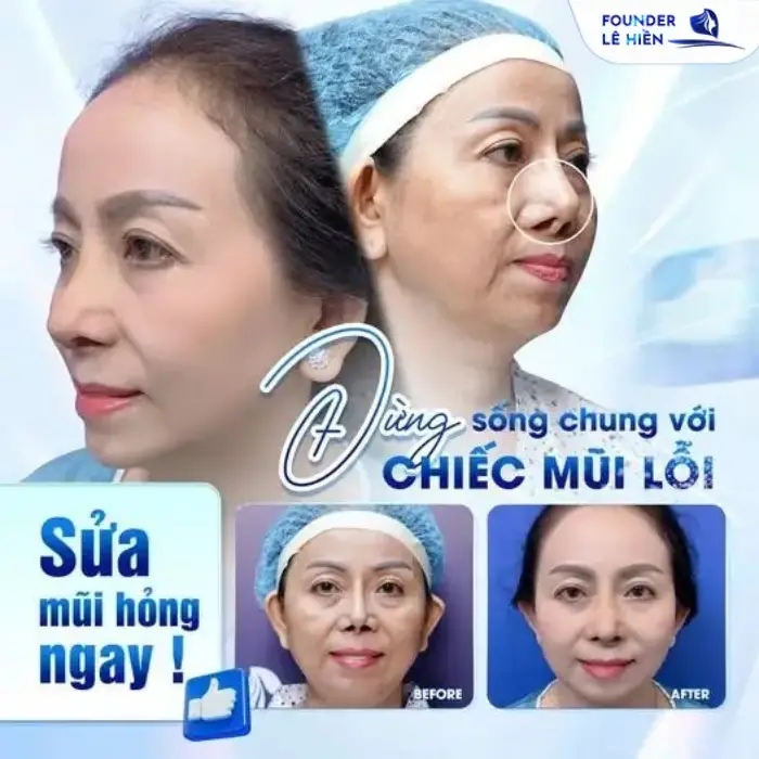 Nâng mũi đẹp từ góc nhìn lâm sàng: Phân tích từng trường hợp và phương pháp tối ưu