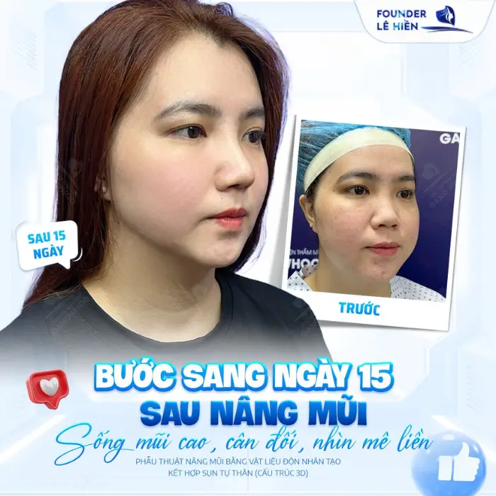 Bí quyết nâng mũi an toàn tự nhiên và đẹp