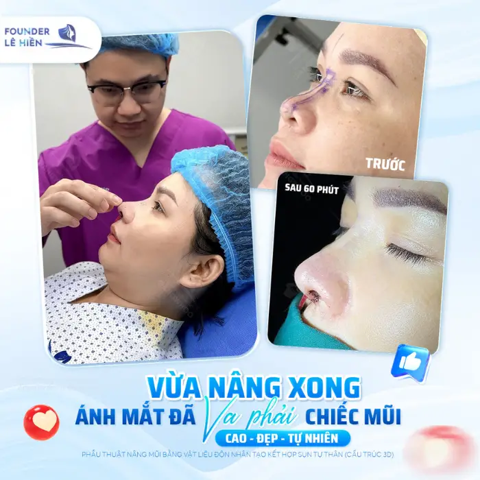 Bí quyết nâng mũi an toàn tự nhiên và đẹp