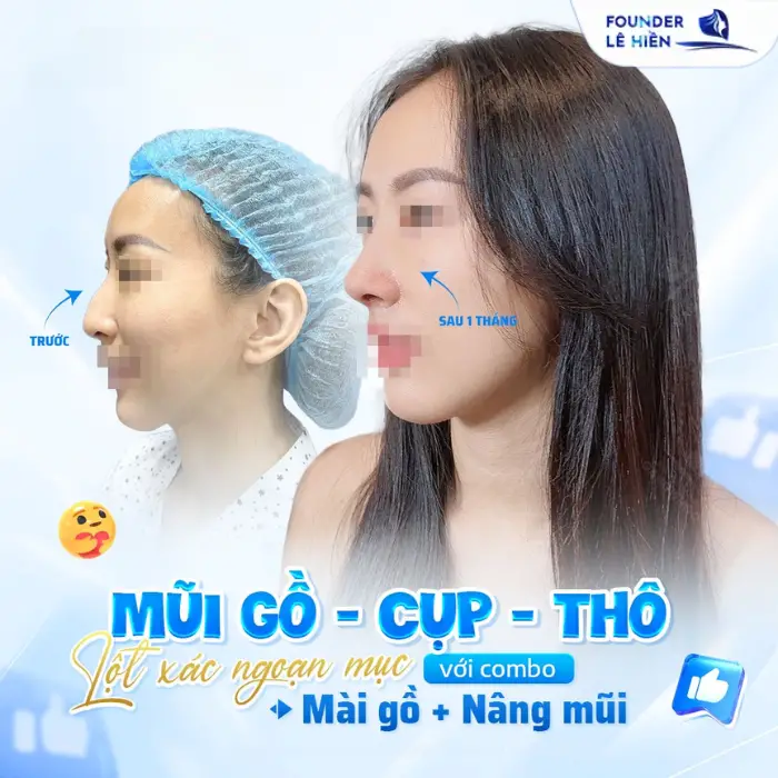 Bí quyết nâng mũi an toàn tự nhiên và đẹp