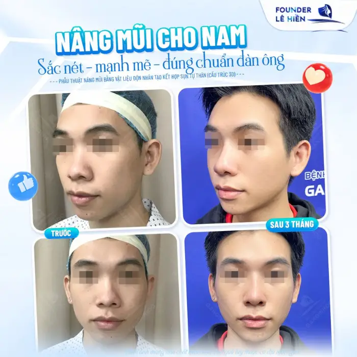 Những sai lầm phổ biến khi nâng sống mũi: Điều bạn cần biết trước khi quyết định