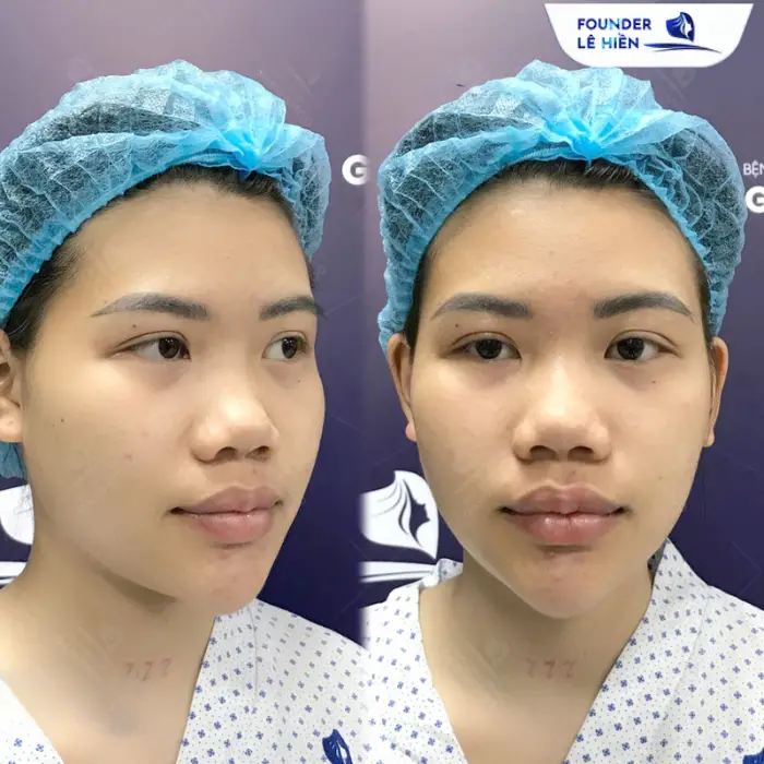 Những sai lầm phổ biến khi nâng sống mũi: Điều bạn cần biết trước khi quyết định