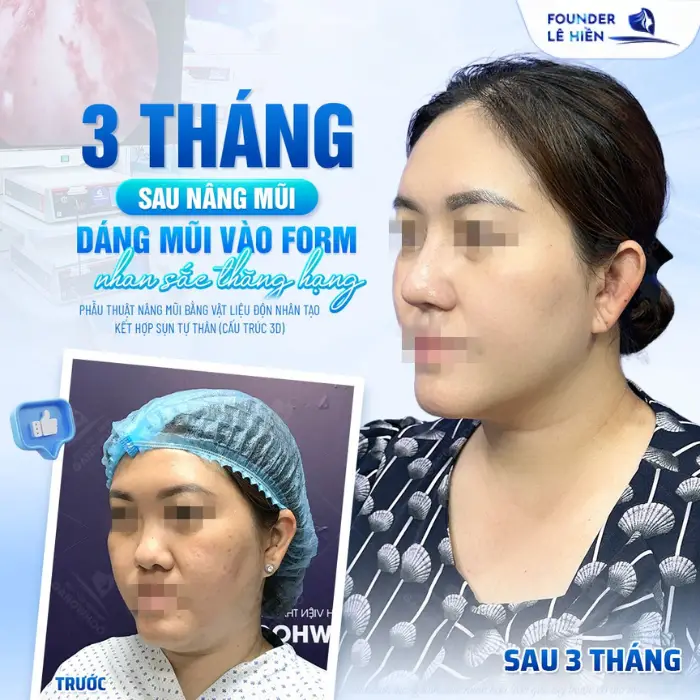 Những sai lầm phổ biến khi nâng sống mũi: Điều bạn cần biết trước khi quyết định