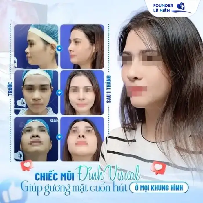 Những sai lầm phổ biến khi nâng sống mũi: Điều bạn cần biết trước khi quyết định