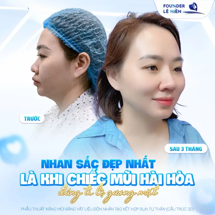 Những sai lầm phổ biến khi nâng sống mũi: Điều bạn cần biết trước khi quyết định