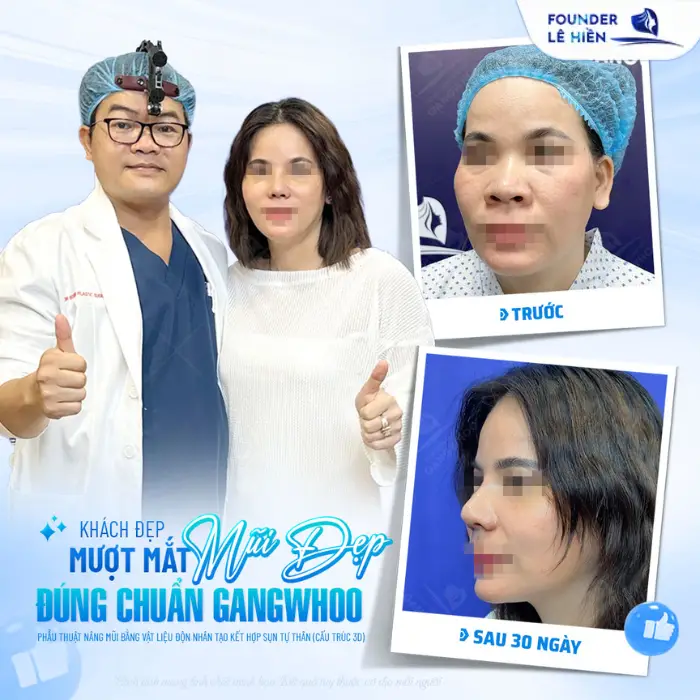 Những sai lầm phổ biến khi nâng sống mũi: Điều bạn cần biết trước khi quyết định